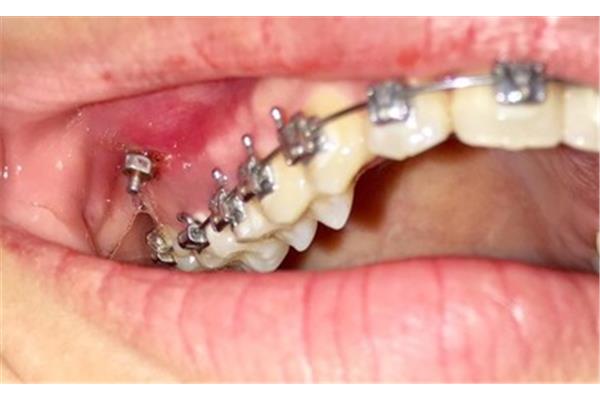 用牙套多久打骨釘,帶牙套的指甲一般要多久才能取出?