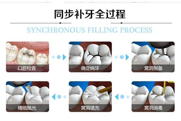 樹脂補牙多久能刷牙? 3m納米樹脂補牙能用多久