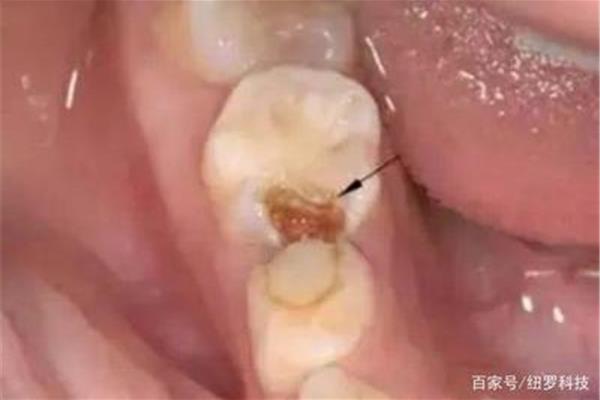 蛀牙如何讓它停止腐蝕蛀牙補完就完事了嗎?