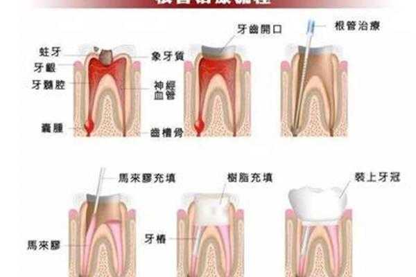 完成牙齒矯正需要多久? 牙延長后能保持多久