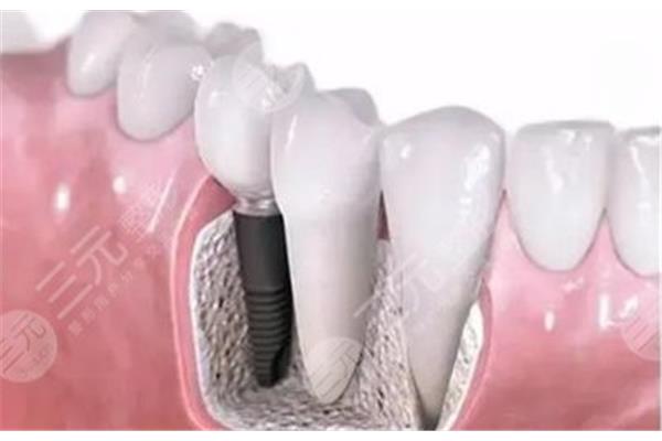 門牙種植牙能管多久