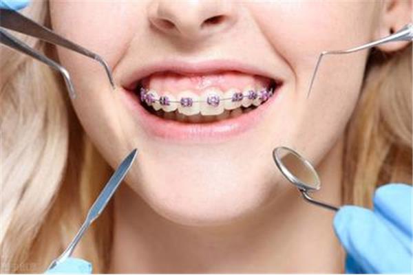牙齒矯正需要多長時間?一般在兩年內