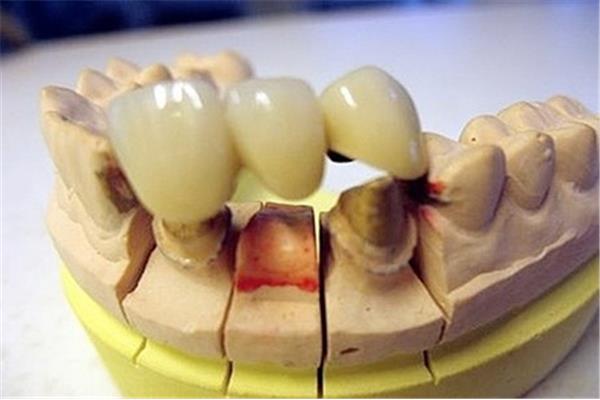 全口種植牙，或稱完全無牙床種植