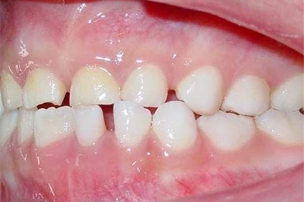 牙齒稀疏帶牙套多久