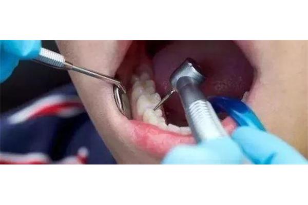 牙齒補洞能用多久