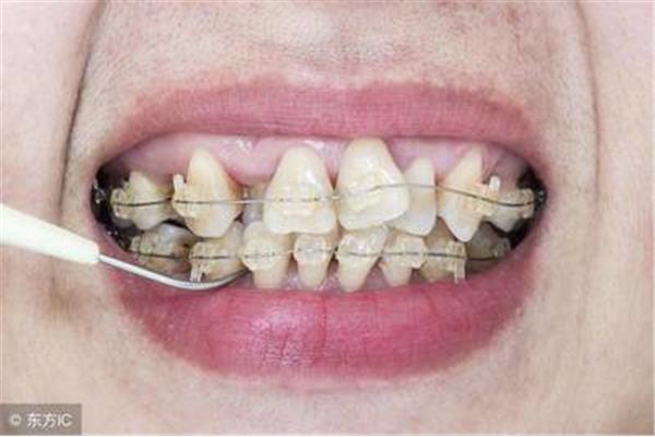 拔牙后多久可以鑲牙?一般在三周內鑲牙
