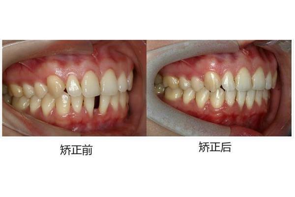 一般牙齒矯正需要多久時間 整牙合縫要多久
