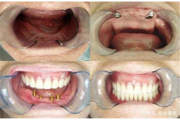 上頜牙槽骨萎縮16歲病患成功種牙