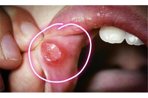 牙齦炎和牙周炎有何不同? 慢性牙周炎紅腫一般多久消腫