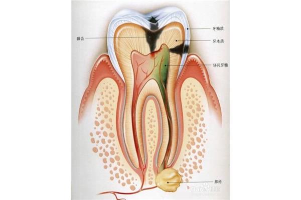 牙根尖周炎怎么治療? 慢性根尖炎要多久才能治好