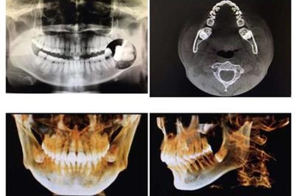 拔牙前拍片可觀察牙根形態及鄰近組織關系