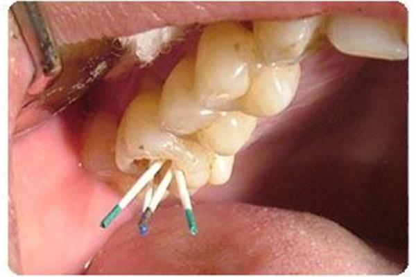 蛀牙爛神經一般經過什么步驟?