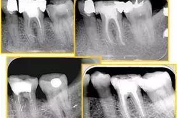 牙齒塑化用多久