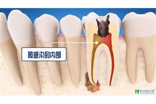 哪些牙齒需要根管治療,蛀牙怎么辦?