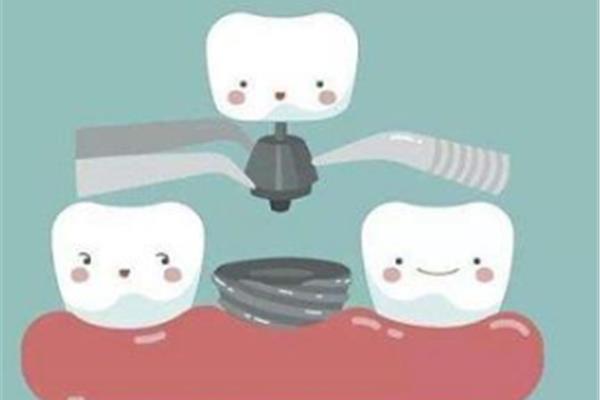 補牙需要多長時間? 牙齒補牙材料能維持多久?