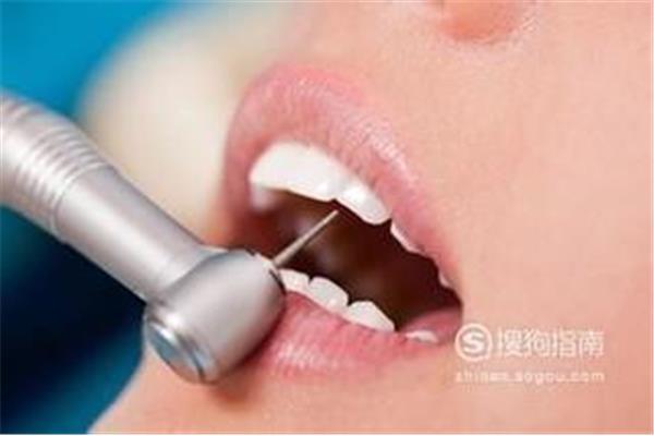 超聲波潔牙術 洗牙多久一次比較好