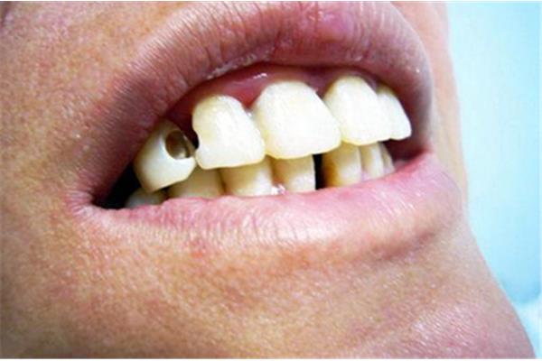 補過的牙能用多久? 堵門牙能堅持多久