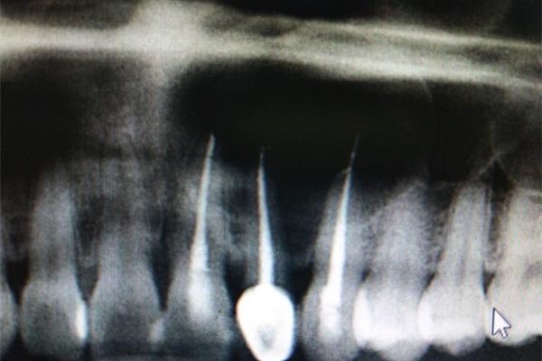 牙根斷裂一般醫生取下斷牙牙保留根根