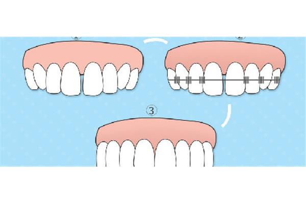 牙齒矯正需要帶多久的牙套?