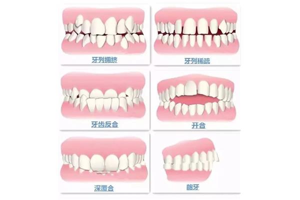 牙齒矯正需要多長時間? 32歲正畸牙齒排齊要多久