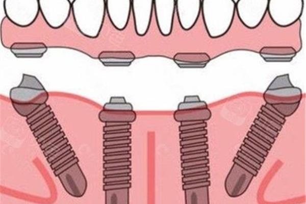種牙需要多長時間?一般需要36個月