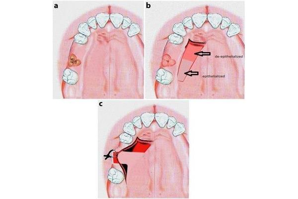 牙周基礎治療:消除牙齦炎癥造成水腫充血松軟
