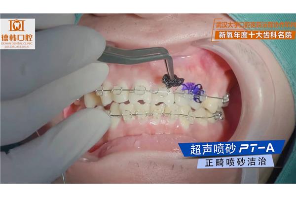 你多久清潔一次牙齒?武漢大學口腔醫院的清洗過程