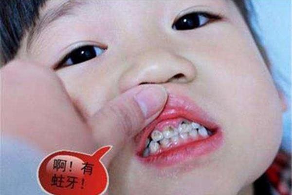 蟲牙形成黑點需要多長時間?寶寶一般幾歲有蟲牙?