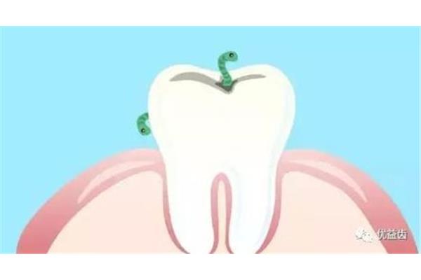 牙齒蛀牙多久復診一次