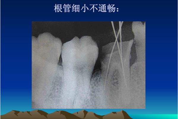 什么是鈣化,牙齒鈣化是什么樣子的?