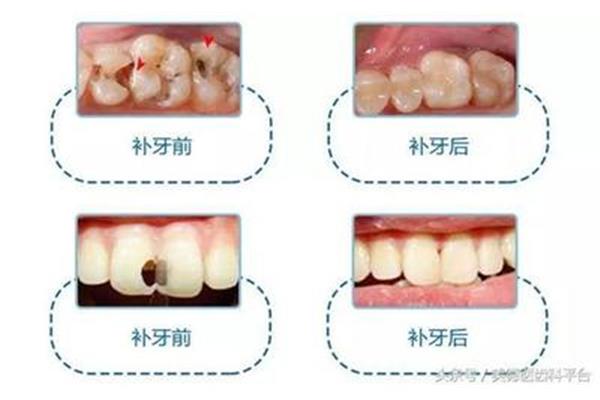 補牙后牙疼要幾天才能好,根管治療后幾天就能補牙