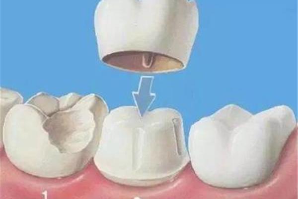 拔牙后多久可以種牙,拔牙后多久能恢復正常?