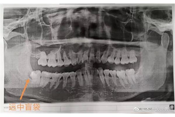 阻生智齒拔牙后多久會腫,上頜智齒多久能恢復?