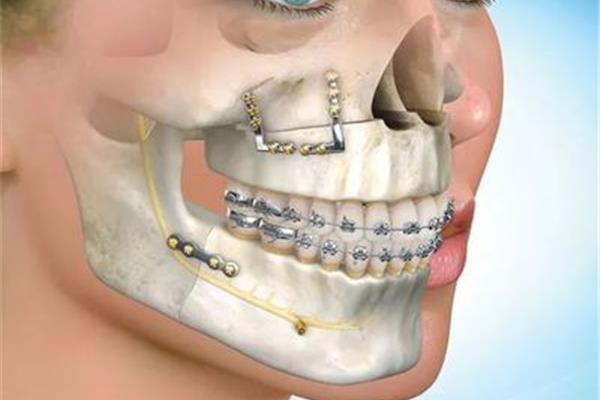 正畸正頜手術需要多長時間?牙齒矯正和正頜手術要多少錢?