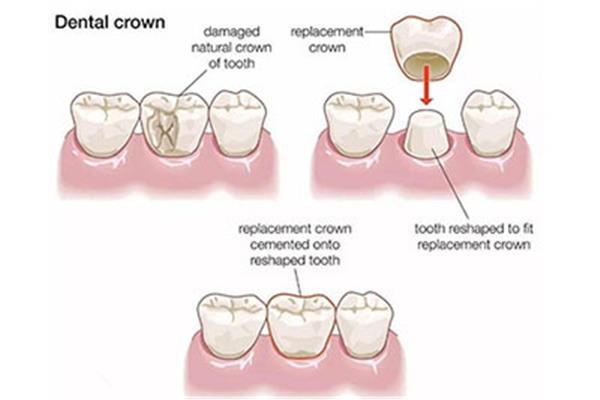 齲齒補牙后的「壽命」有多長?磨牙會影響牙齒壽命嗎?
