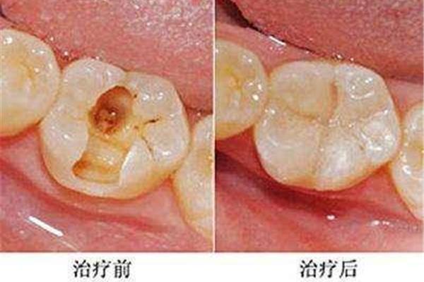 哪些牙齒要做根管治療,為什么要做根管治療?