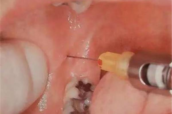上頜磨牙阻滯和下頜磨牙阻滯的位置