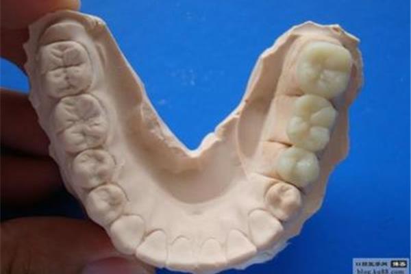 臨時樹脂牙可以戴多久
