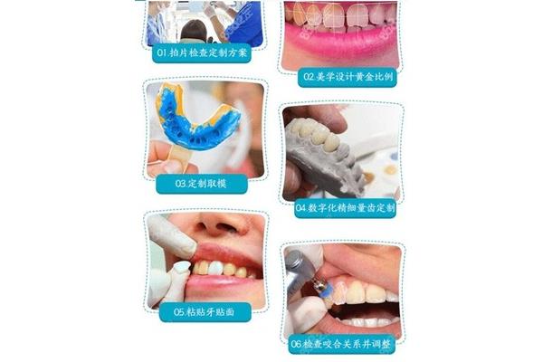 做瓷貼面工藝,洗牙后多久可以做牙齒貼面?