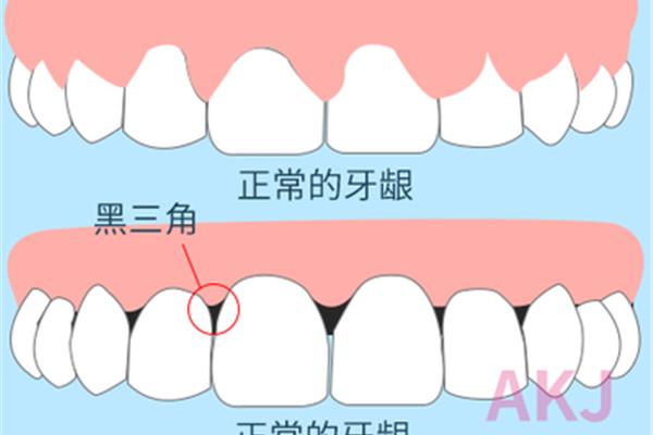 拔牙后其他牙齒會松動多久,拔牙后會有多久的疼痛?