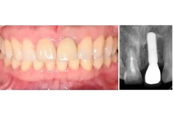 門牙要多久才能長出來,門牙旁邊的牙能長出來多久?