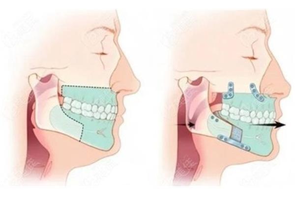 正畸排齊階段一般需要多久,正畸虎牙排齊需要多久?