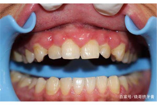牙齦切開需要多長時間恢復,牙齦手術需要多長時間恢復?