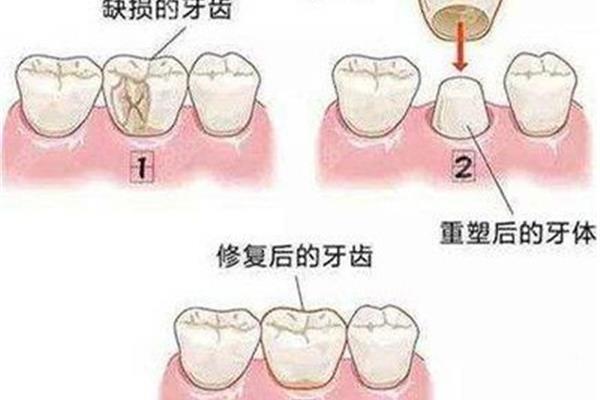 治療后的牙齒能用多久