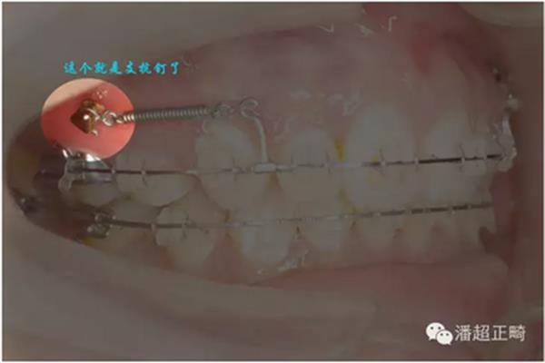 種植體支抗植入前牙的視頻,正畸種植體支抗需要多久才能施力