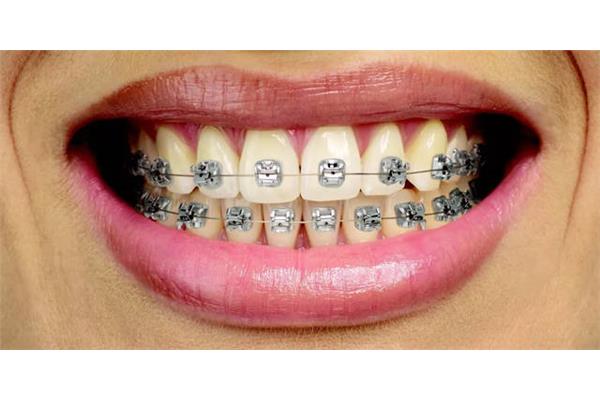 牙模后多久戴牙套,牙套做完多久可以正常吃飯?
