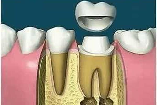 修復牙神經需要多長時間?什么是假牙?