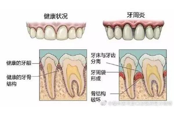 種牙需要多長時間?福州哪家醫院種牙最好?