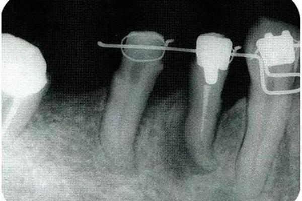 正畸臨時牙冠,正畸臨時牙冠能用兩三年嗎?