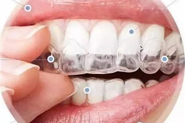 取下牙套后需要多久佩戴固位體,調整牙套需要多久?